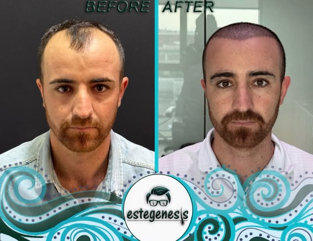 Day 10 after hair transplant surgery. He chose our clinic for his hair transplant. He was very upset