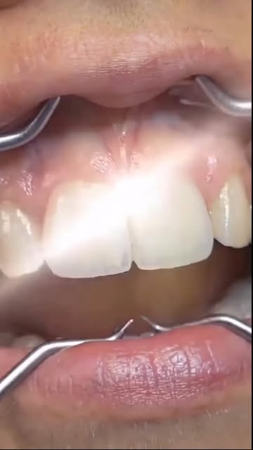 Decay between the front teeth can affect both your oral health and your smile. 🦷✨

At Estegenesis C