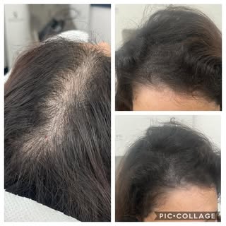 SMP is a game changer for ladies with thinning hair.  Confidence totally restored 😍😍 #THESCALPCLIN