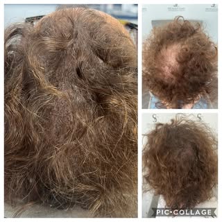SMP works to add density with a whole range  of hair colours. For this client we used Folicle brown.