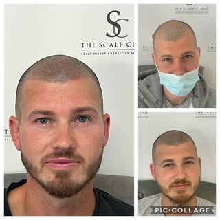 Lovely to see this client back for a ‘Top Up’ after his original treatment 3 years ago.  A top up us