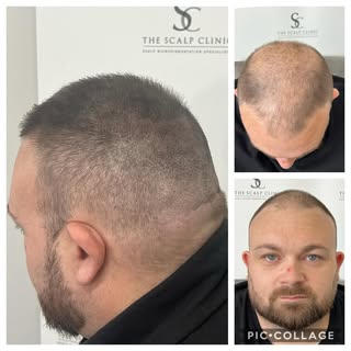 Another life changing result through density work..: confidence totally restored 😍 THESCALPCLINIC 

