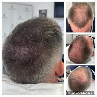 It took for sessions but wow what a difference 😍 #THESCALPCLINIC 
#SMP #SCALPMICROPIGMENTATION #HEL