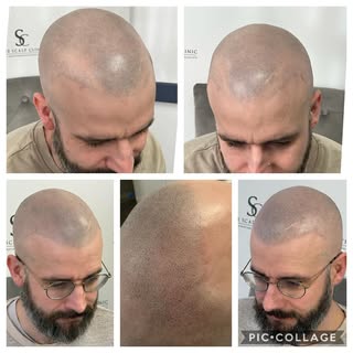 Not every client needs a new hair line… this client was delighted with the results of using SMP to c