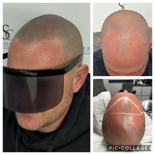 Absolutely loved creating this hair line….😍…. Such an awesome result. Confidence totally restored. 