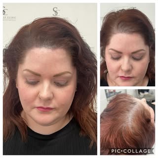 Top up treatment for one of my lovely female clients who suffers with thinning hair….SMP is perfect 