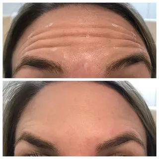 Wrinkle free...life
Midas @8003085085
#botoxtreatment 
#wrinklefree 
#painless 
#instantresults