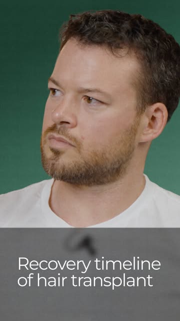 What should you expect 7 days after a hair transplant?

At this stage, some redness, scabbing and se