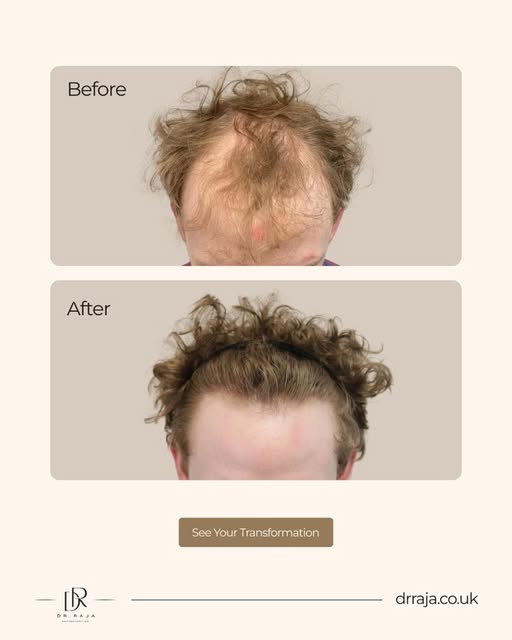 David’s result at 12 months.

Curly hair requires a particularly considered approach to FUE. The nat