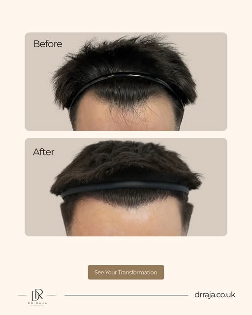 Sometimes, subtle makes the biggest difference.

Thomas wanted to address recession and thinning at 