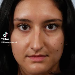Refined. Natural. Scarless. #rhinoplasty #drsfacialplasticsurgery #classy #firstclass