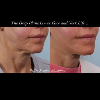 The Deep Plane Lower Face and Neck Lift by yours truly! #drsfacialplasticsurgery #deepplanefacelift 