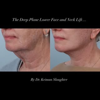 With a Deep Plane Neck Lift, one of my main goals is to create a more naturally contoured neck and a
