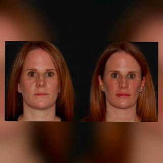 Before and immediately after non-surgical facial balancing with #fillers. By highlighting the midfac