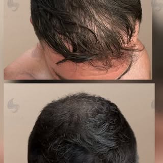 4,000 grafts. 6 months. Still improving.
An incredible transformation achieved with 4,000 grafts usi