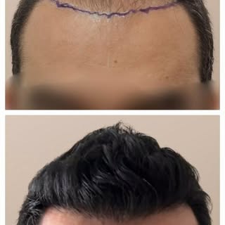 4,300 grafts. One natural transformation.
A successful hair transplant isn't about using the highest