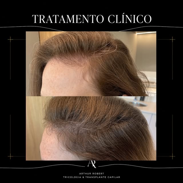 Afinamento capilar feminino não é “coisa da idade” — é uma condição médica com causas específicas e 