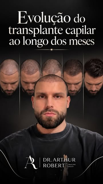 A linha do tempo real de um transplante capilar.

Mês 1 — os fios transplantados caem. Isso é espera