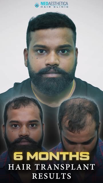 Natural hair restoration built on expertise and precision.

Tags: natural looking hair, hair growth,