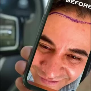 ¡Los resultados de Javi son de otro nivel!
Gracias a la técnica FUE en Cancun Hair Restoration, cons