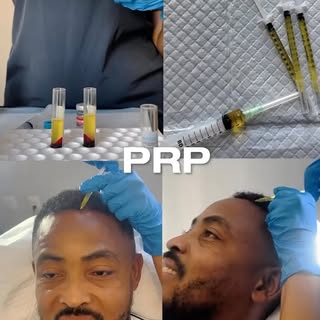 ✅Revitaliza tu cabello desde la raíz con PRP.

El Plasma Rico en Plaquetas (PRP) ayuda a estimular e
