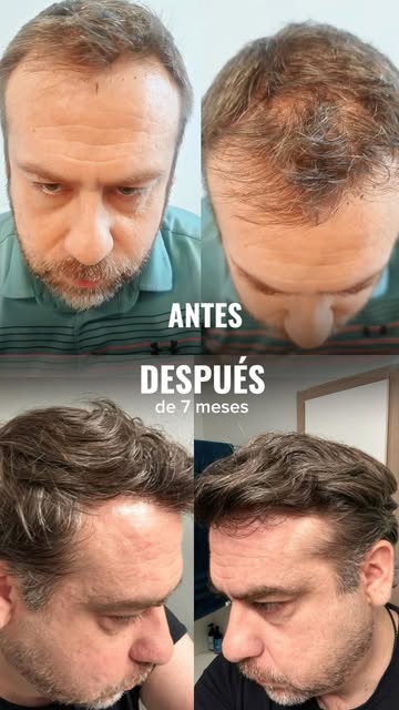 ✨ Un cambio que habla por sí solo.

Hoy te mostramos el antes y después de uno de nuestros casos de 