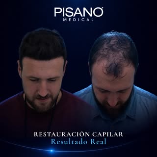 La evolución de un caso de restauración capilar no se mide solo por la cantidad de cabello recuperad