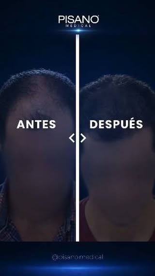 Un cambio que se nota. Un resultado que se ve natural.

En este caso, la evolución permite apreciar 