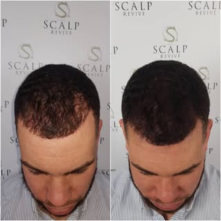 1st session adding density to this hair transplant hairline #smplife #scalprevive #scalpartistacadem