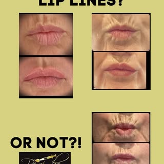 The tiny lines above your lip can age your face more than wrinkles anywhere else… but they’re often 