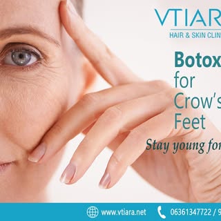 Crow's feet, a common concern, are those little lines spreading out from the corners of your eyes. C