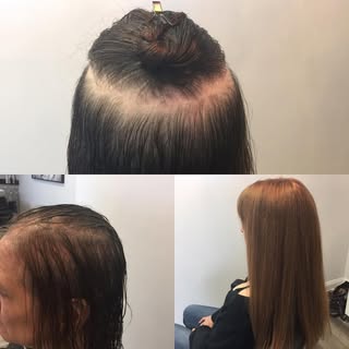Step-by-step of the process of hair restoration. The attached hair piece stays for four weeks and ca