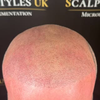 1st session ⬆️
If you have had a hair transplant but your still left with thinning hair, we can make