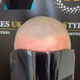 Scalp micropigmentation is the only guaranteed hair loss solution.

At Scalp Styles UK, we offer a r