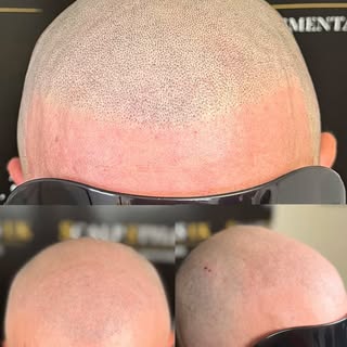 Scalp micropigmentation is the only guaranteed hair loss solution.

At Scalp Styles UK, we offer a r