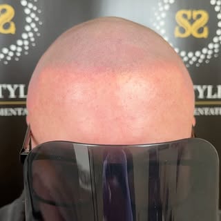 This client had Smp from a previous provider but wasn’t happy with the hairline as it was to straigh