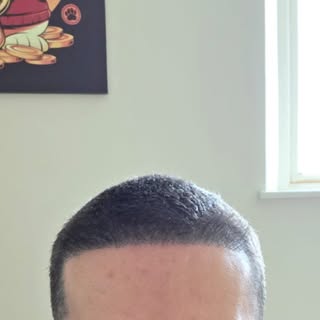 If you have had a hair transplant but you’re still not happy with the results and still have thinnin
