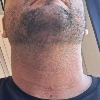 Small patch on this clients beard camouflaged with Smp 🧔‍♂️ 

#beardsmp #beardsmptattoo #smp #scalp