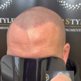#smp #scalpmicropigmentation #smpliverpool #hairtattoo #hairlosstreatment