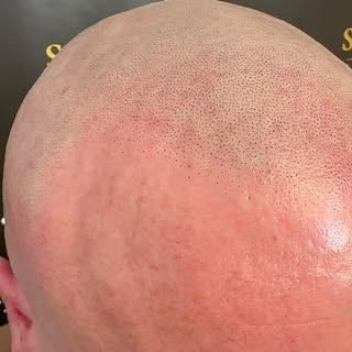 #scalpmicropigmentation #smp #hairtattoo #hairlosstreatment #hairlossspecialist