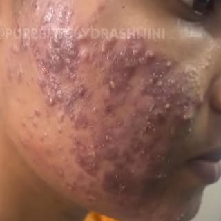 acne journey #insta #instagram #instagood #instafashion #acne #clear