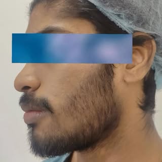 #LaserForBeard #BeardLaserTreatment #LaserBeardShaping #BeardLaserCost #BeardLaserHyderabadskin