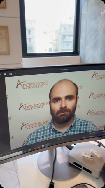 🔥 Στάδιο 6 προς 7. Λεπτή τρίχα. Μεγάλη επιφάνεια. Και όμως, μεγάλη αλλαγή από την πρώτη κιόλας επέμ