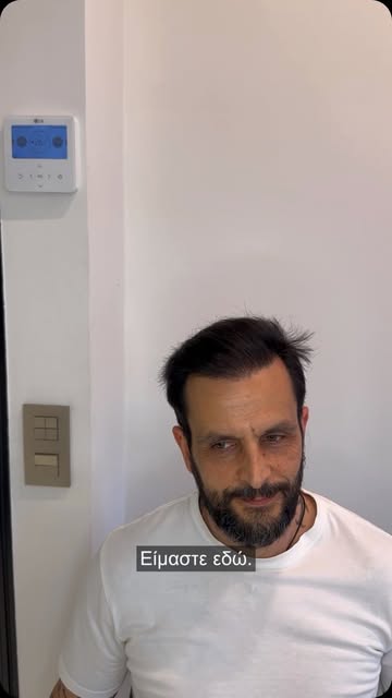 🔥 Στάδιο 6. 2 μεταμοσχεύσεις. 4.700 τριχοθυλάκια.

Ο Νίκος ήρθε με μεγάλη επιφάνεια αραίωσης και έν