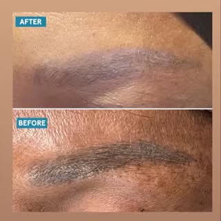Look at this amazing non-laser tattoo removal result after 3 sessions #tattooremoval #beforeandafter