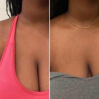 Stretch marks camouflage. An effective way to reduce the appearance of stretch marks.

This is heale