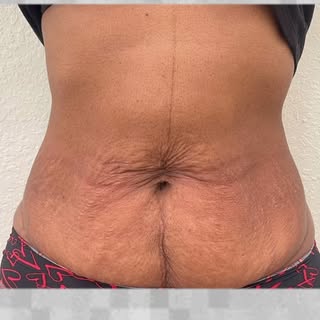 Stretch mark camouflage #stretchmarktreatment #stretchmark #stretchmarkcamouflage #vancouverwa #stre