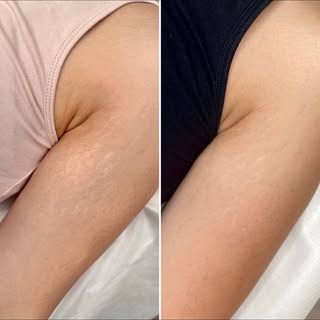 Inkless stretch mark revision. An effective way to reduce the appearance of stretch marks.

Photo (l