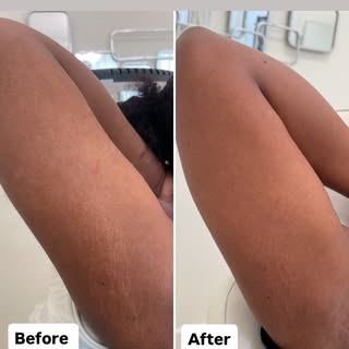 Stretch Mark Camouflage 

COSMETAT 
113 W 7th Street
Vancouver WA 98660 

By Appointment only.
DM to