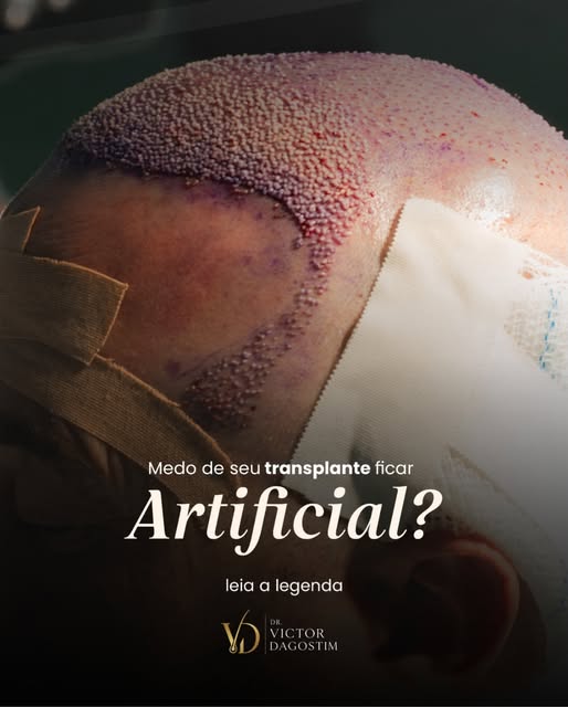 Naturalidade no transplante capilar está relacionada a diferentes aspectos do planejamento.

Desenho